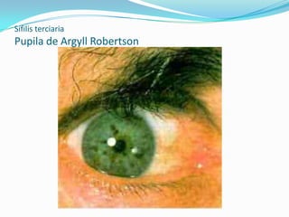 Sífilis terciaria
Pupila de Argyll Robertson
 