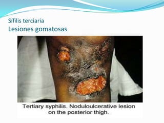 Sífilis terciaria
Lesiones gomatosas
 