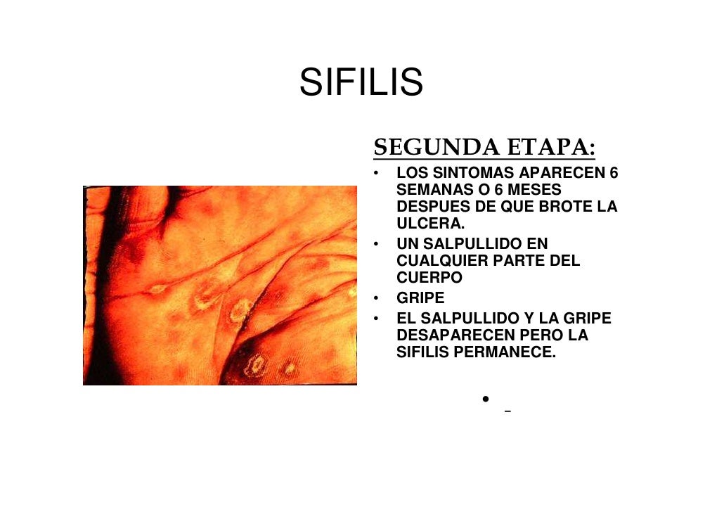 Sifilis