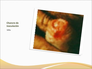 Sifilis | PPT