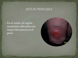 sifilis-pptx