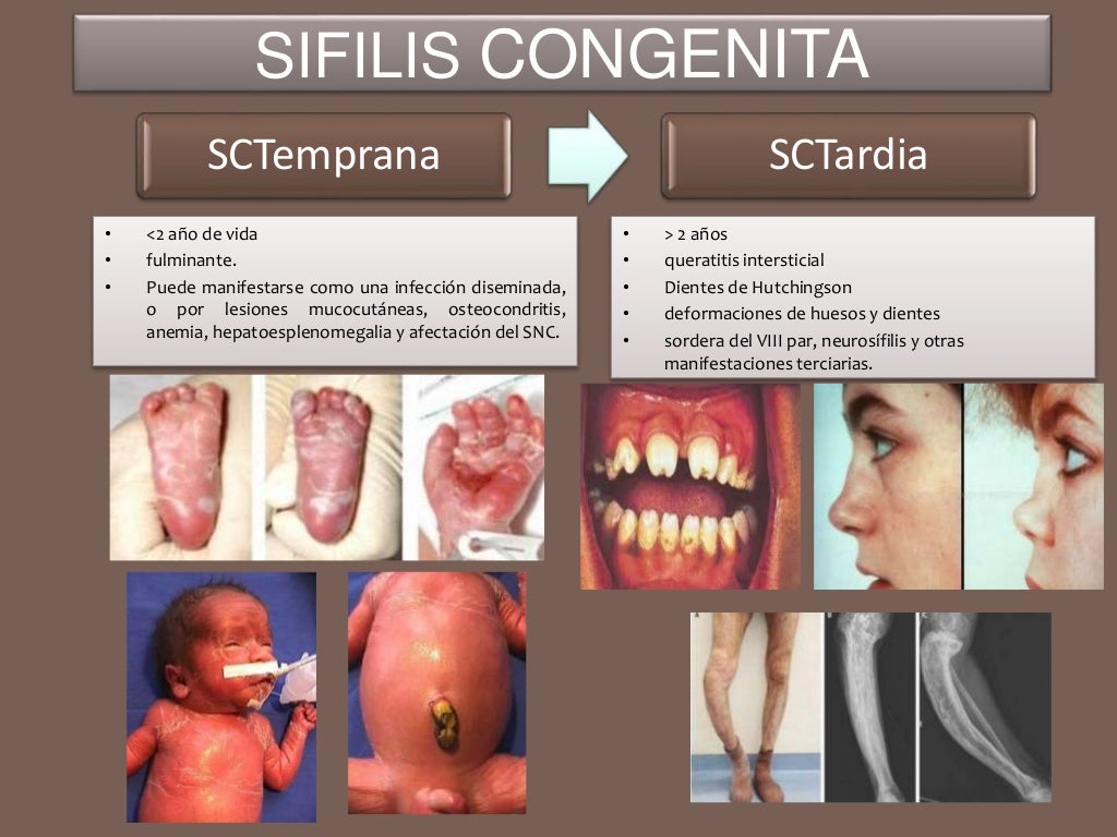 SIFILIS FASES CUADRO CLINICO DIAGNOSTICO TRATAMIENTO SIFILIS FASES CUADRO CLINICO DIAGNOSTICO TRATAMIENTO