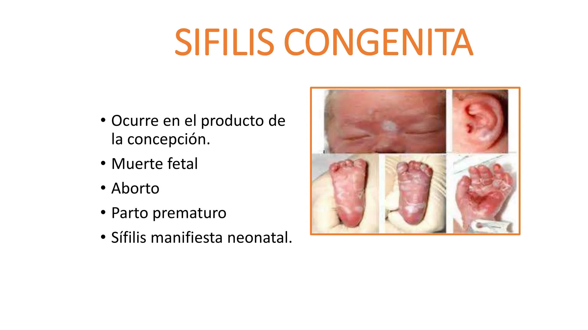 sifilis-enfermedades-de-transmision-ual-pptx
