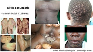 Sífilis secundária
• Manifestações Cutâneas:
Fonte: arquivo do serviço de Dermatologia do HCL
 