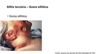 Sífilis terciária – Goma sifilítica
• Goma sifilítica
Fonte: arquivo do serviço de Dermatologia do HCL
 