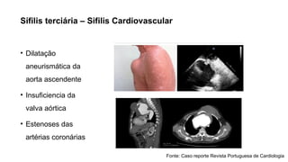 Sífilis terciária – Sifilis Cardiovascular
• Dilatação
aneurismática da
aorta ascendente
• Insuficiencia da
valva aórtica
• Estenoses das
artérias coronárias
Fonte: Caso reporte Revista Portuguesa de Cardiologia
 