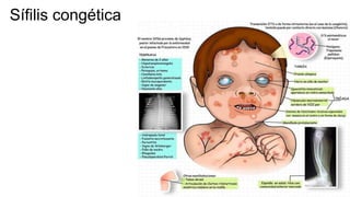 Sífilis congética
 
