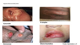 Diagnóstico Diferencial da Sífilis primária
•
Cancroide
H simples
Donovanose Úlcera traumatica Fonte: Seminário L.H
 