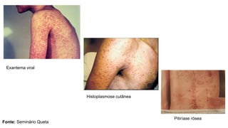 Exantema viral
Histoplasmose cutânea
Pitiríase rósea
Fonte: Seminário Queta
 
