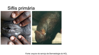 Siflis primária
Fonte: arquivo do serviço de Dermatologia do HCL
 