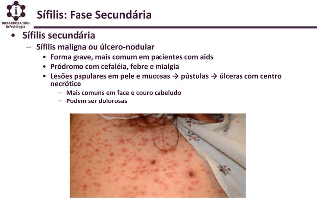 Sifilis Manejo e Tratamento Medicos Atencao Basica 2019 | PPT