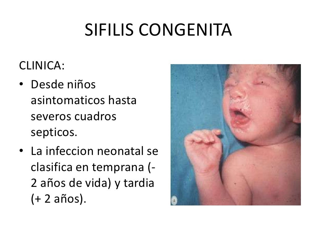 Sifilis congenita