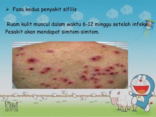 Sifilis, dan hiv pada kanak-kanak