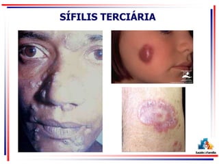 SÍFILIS TERCIÁRIA
 