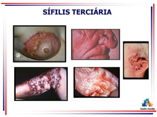 SÍFILIS TERCIÁRIA
 