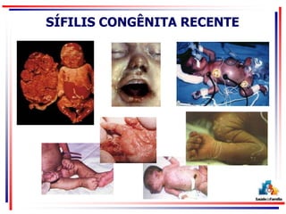 SÍFILIS CONGÊNITA RECENTE
 