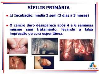 SÍFILIS PRIMÁRIA
 t Incubação: média 3 sem (3 dias a 3 meses)
 O cancro duro desaparece após 4 a 6 semanas
mesmo sem tratamento, levando à falsa
impressão de cura espontânea.
 