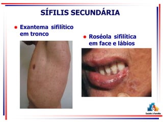 SÍFILIS SECUNDÁRIA
 Exantema sifilítico
em tronco  Roséola sifilítica
em face e lábios
 