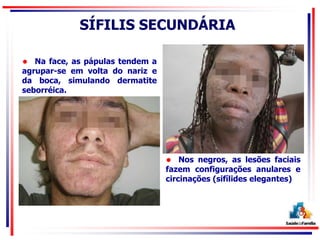 SÍFILIS SECUNDÁRIA
 Na face, as pápulas tendem a
agrupar-se em volta do nariz e
da boca, simulando dermatite
seborréica.
 Nos negros, as lesões faciais
fazem configurações anulares e
circinações (sifílides elegantes)
 