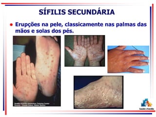 SÍFILIS SECUNDÁRIA
 Erupções na pele, classicamente nas palmas das
mãos e solas dos pés.
 