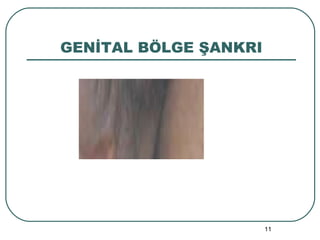 GENİTAL BÖLGE ŞANKRI 