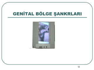 GENİTAL BÖLGE ŞANKRLARI 