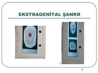 EKSTRAGENİTAL ŞANKR 