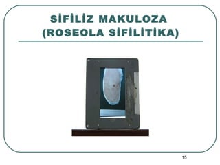 SİFİLİZ MAKULOZA  (ROSEOLA SİFİLİTİKA) 