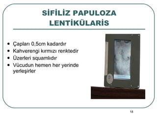 SİFİLİZ PAPULOZA LENTİKÜLARİS Çapları 0,5cm kadardır Kahverengi kırmızı renktedir Üzerleri squamlıdır Vücudun hemen her yerinde yerleşirler 