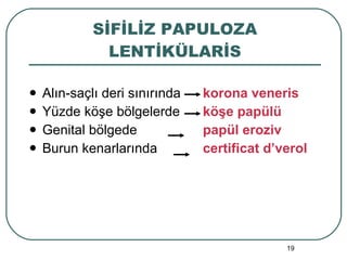 SİFİLİZ PAPULOZA LENTİKÜLARİS Alın-saçlı deri sınırında  korona veneris Yüzde köşe bölgelerde  köşe papülü Genital bölgede  papül eroziv  Burun kenarlarında  certificat d’verol 