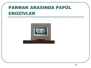 PARMAK ARASINDA PAPÜL EROZİVLER 
