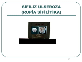 SİFİLİZ ÜLSEROZA (RUPİA SİFİLİTİKA) 