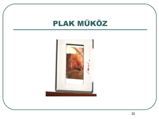 PLAK MÜKÖZ 