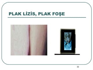 PLAK LİZİS, PLAK FOŞE 