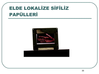 ELDE LOKALİZE SİFİLİZ PAPÜLLERİ 