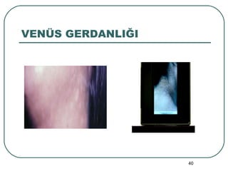 VENÜS GERDANLIĞI 