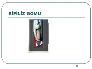 SİFİLİZ GOMU 