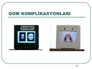GOM KOMPLİKASYONLARI 