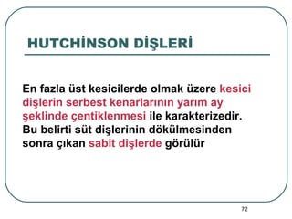 HUTCHİNSON DİŞLERİ En fazla üst kesicilerde olmak üzere  kesici dişlerin serbest kenarlarının yarım ay şeklinde çentiklenmesi  ile karakterizedir. Bu belirti süt dişlerinin dökülmesinden sonra çıkan  sabit dişlerde  görülür 