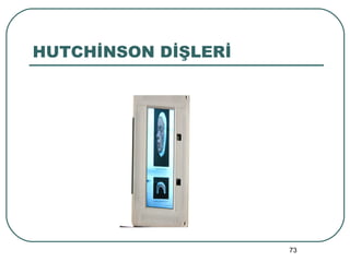 HUTCHİNSON DİŞLERİ 
