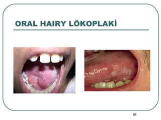 ORAL HAIRY LÖKOPLAKİ 