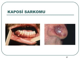 KAPOSİ SARKOMU 