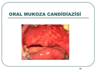 ORAL MUKOZA CANDİDİAZİSİ 