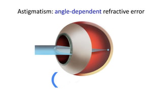 Astigmatism: angle-dependent refractive error
 