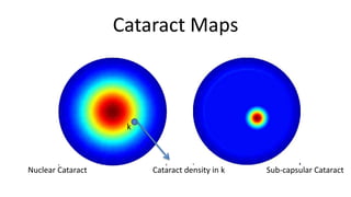 Cataract Maps



                    k



Nuclear Cataract        Cataract density in k   Sub-capsular Cataract
 