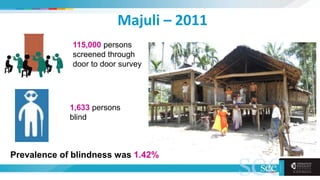 Majuli – 2011
115,000 persons
screened through
door to door survey
1,633 persons
blind
Prevalence of blindness was 1.42%
 