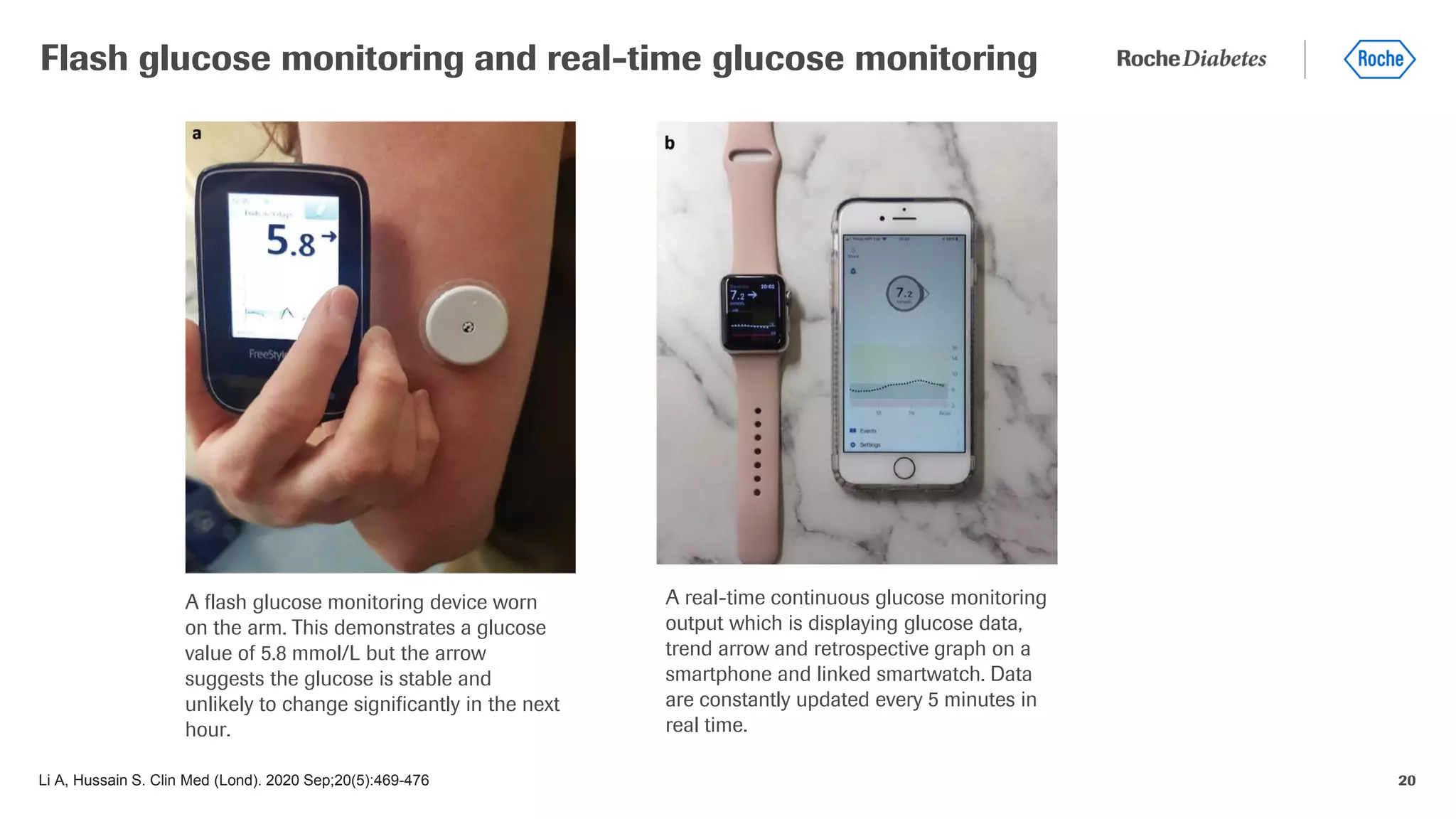 20
Flash glucose monitoring and real-time glucose monitoring
A flash glucose monitoring device worn
on the arm. This demonstrates a glucose
value of 5.8 mmol/L but the arrow
suggests the glucose is stable and
unlikely to change significantly in the next
hour.
A real-time continuous glucose monitoring
output which is displaying glucose data,
trend arrow and retrospective graph on a
smartphone and linked smartwatch. Data
are constantly updated every 5 minutes in
real time.
Li A, Hussain S. Clin Med (Lond). 2020 Sep;20(5):469-476
 