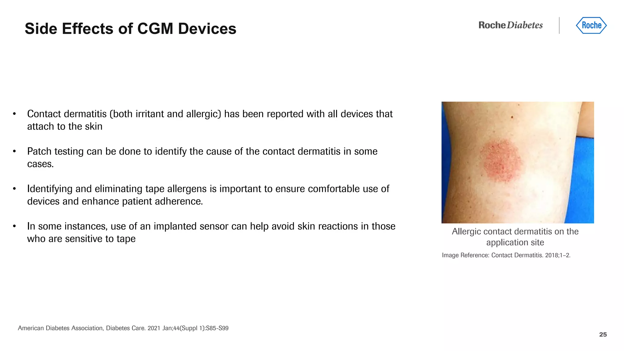 25
• Contact dermatitis (both irritant and allergic) has been reported with all devices that
attach to the skin
• Patch testing can be done to identify the cause of the contact dermatitis in some
cases.
• Identifying and eliminating tape allergens is important to ensure comfortable use of
devices and enhance patient adherence.
• In some instances, use of an implanted sensor can help avoid skin reactions in those
who are sensitive to tape
Side Effects of CGM Devices
American Diabetes Association, Diabetes Care. 2021 Jan;44(Suppl 1):S85-S99
Allergic contact dermatitis on the
application site
Image Reference: Contact Dermatitis. 2018;1–2.
 