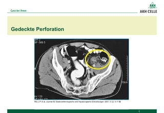 Gedeckte Perforation
 