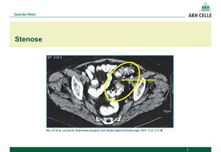 Stenose
 